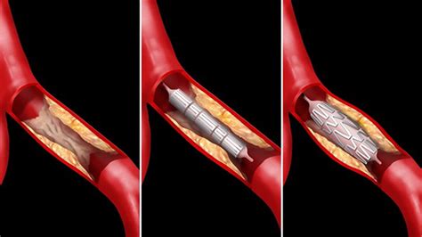 Stenting Varicose Veins Vascular Surgeon Stroke Dvt Leg