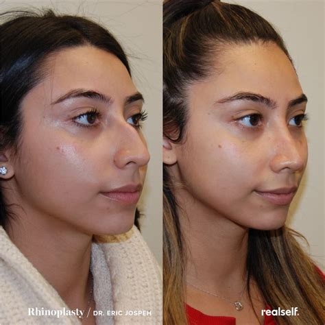 10 Step Rhinoplasty Recovery Timeline Rhinoplasty Recovery Nose