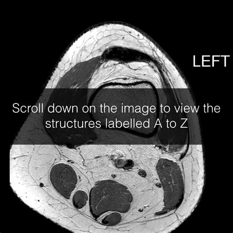 Mri patterns of neuromuscular disease involvement thigh & other muscles 2. Anatomy Knee Axial Mri - Human Anatomy