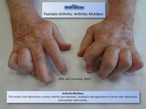 Psoriatic Arthritis · Rheumtutor