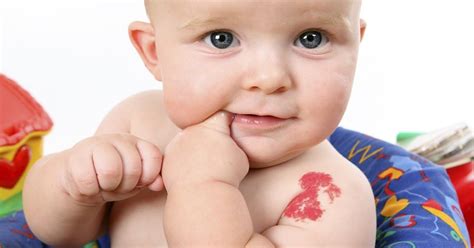 What Are Birthmarks Types And Treatments Upmc Healthb