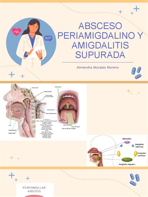 Absceso Periamigdalino Y Amigdalitis Supurada Almendra Morales Moreno