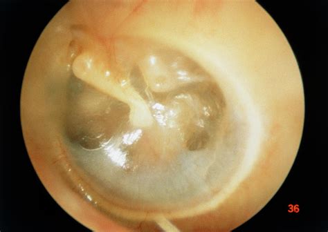 Otitis Media Of Ear Photograph By Professor Tony Wright Institute Of
