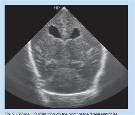 Figure 2 From Bilateral Periventricular Nodular Heterotopia Neonatal