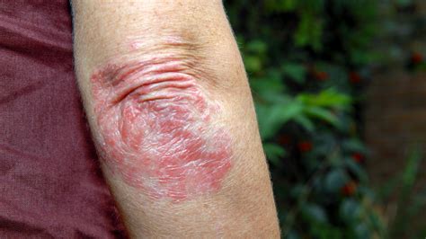 Crohns Disease And Skin Issues Rashes And More