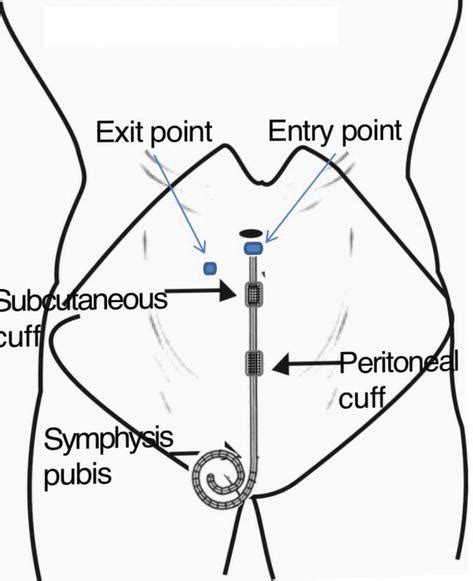 Techniques For Peritoneal Dialysis Catheter Placement Intechopen