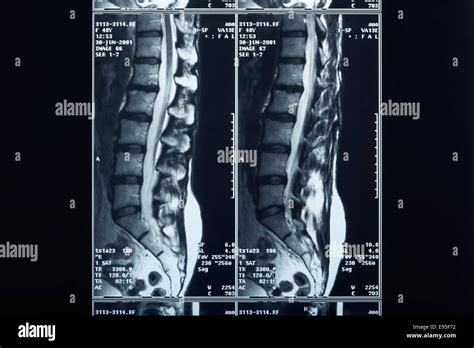 X Ray Spine Radiography Stock Photo Alamy