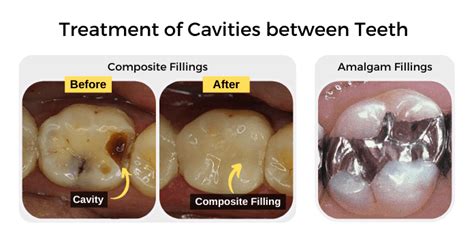 Cavities In Between Teeth Causes And Treatment Share Dental Care