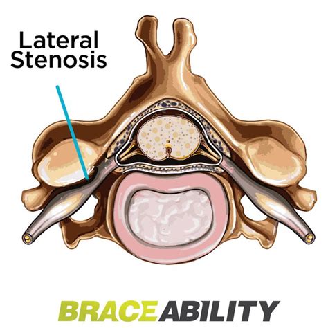 The Difference Between Foraminal Central And Lateral Recess Stenosis In