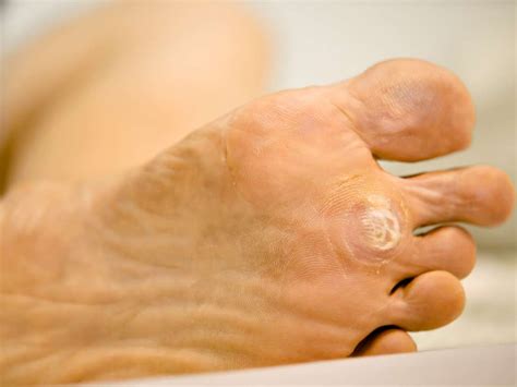 Plantar Warts Symptoms Causes And Treatment