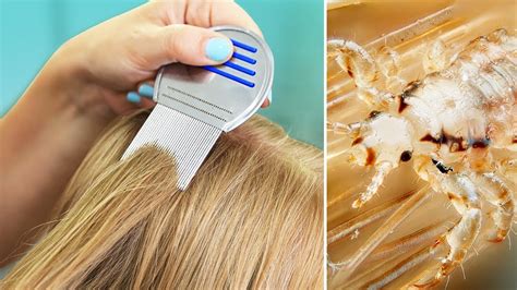 Top 104 How To Reduce Lice In Hair