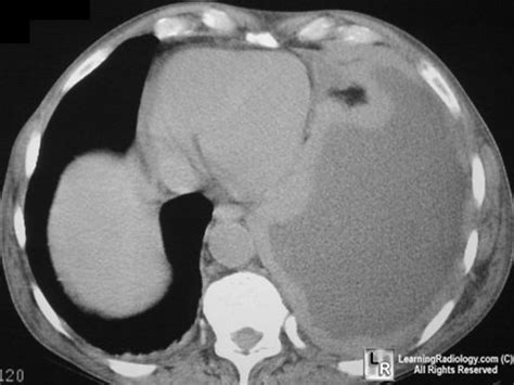 Treatment for malignant mesothelioma may include surgery, radiation therapy, and chemotherapy treatment of recurrent malignant mesothelioma. LearningRadiology - Mesothelioma, radiology, malignant ...