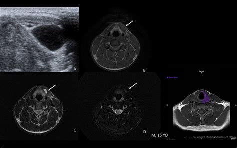 Thyroglossal Duct Cyst M 15 Yo Presenting With Midline Neck