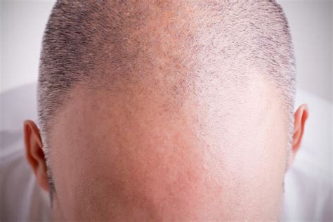 Candidates For A Hair Transplant Toronto Facial Plastic Surgery And