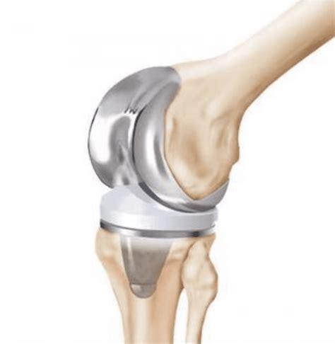 Revision Joint Replacement Surgery Midwest Center For Joint Replacement Hip And Knee