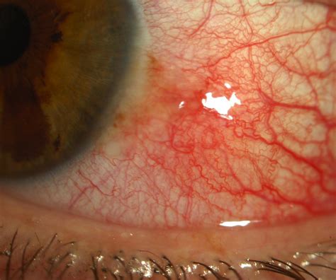 Uveitis Differential Diagnoses 42 Westmead Eye Manual