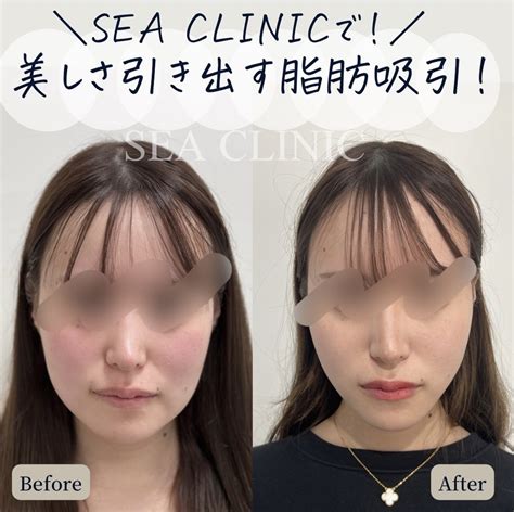 美しさを引き出す脂肪吸引 Sea Clinic −シークリニック 銀座― 理想を叶える小顔治療