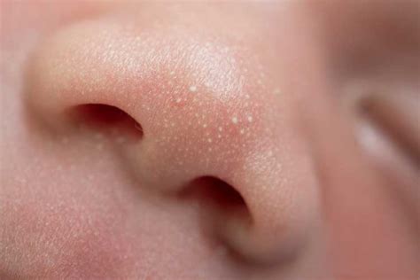 How To Treat Baby Rashes At Home Tips And Remedies