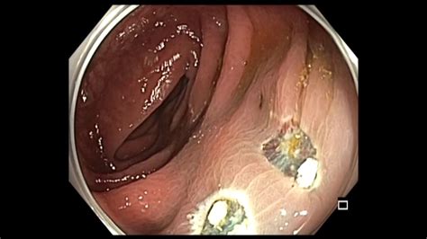 It receives digested food from the small intestine, from which it absorbs water and ions to. Colonoscopy: Subtle polyp - transverse colon - YouTube