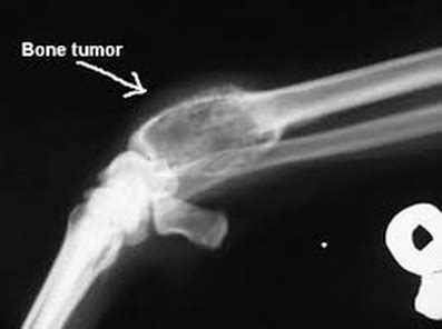 Bone metastases are made up of abnormal cancer cells that started from the original (primary) tumor site. Bone Cancer - Infectious knowledge