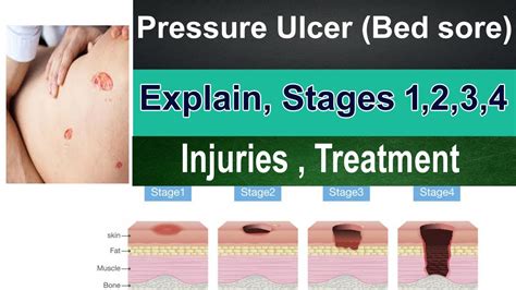 Pressure Ulcer Bed Sores Pressure Ulcer Stages