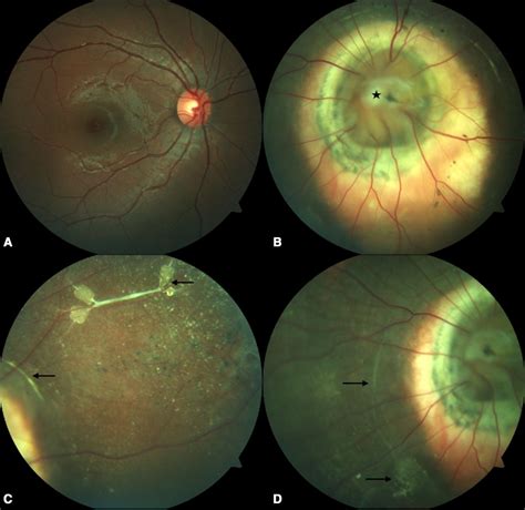 Salt And Pepper Like Retinopathy In A Case Of Morning Glory Disc