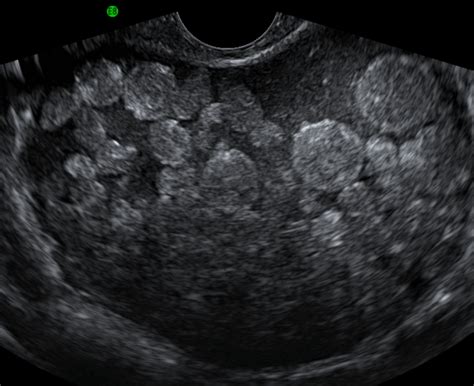 Ovarian Dermoid Diagnostic Medical Sonography Obstetric Ultrasound