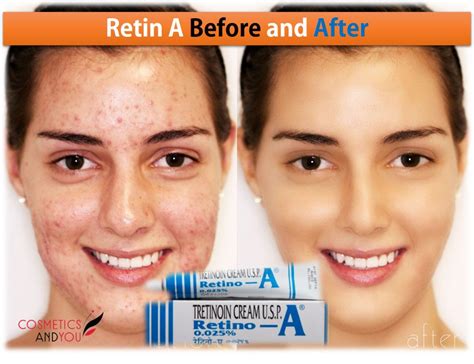 Retin A Before And After Cosmetics And You Acne Treatment