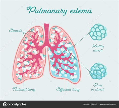 Edema Pulmonar Anat Micos Infante The Best Porn Website