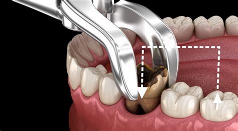 Trasplante Dental Tipos Y Ventajas Clínica Tacna
