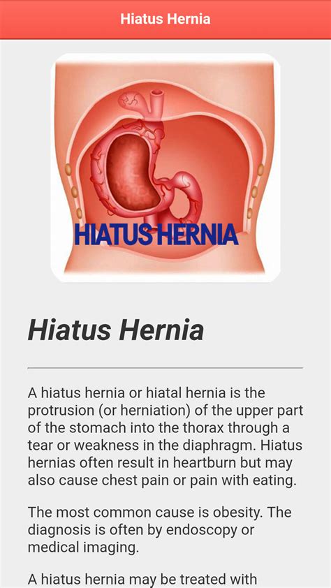 Hiatus Hernia Diseasejpappstore For Android