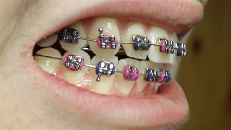 Penjagaan gigi yang baik termasuklah gigi anda bersih dan bebas daripada sebarang kotoran terdapat pelbagai cara dan kaedah yang boleh dicuba termasuklah memberus gigi anda 2 kali sehari. Pendakap Gigi (Braces): Kegunaan dan Penjagaan - The Diagnosa