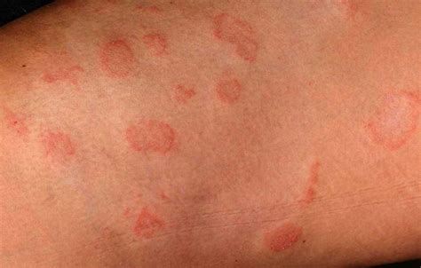 Nummular Eczema Vs Ringworm Symptoms Causes And Treatment