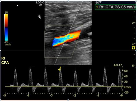 Interpretation Of Peripheral Arterial And Venous Doppler 42 Off