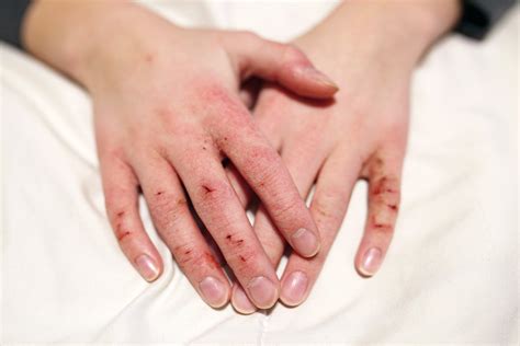 How To Rescue Dry Cracked Hands From Handwashing Aos Skincare
