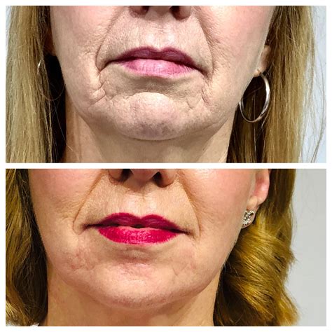 Lower Face Jaw Lines Ashbrooke Cosmetic Surgery