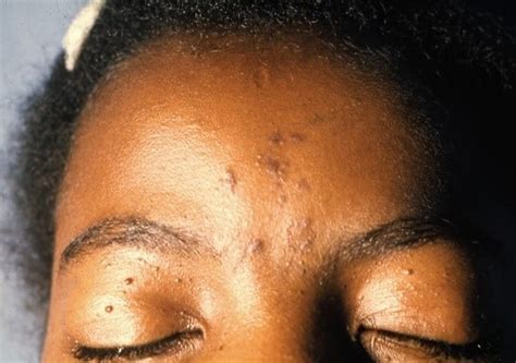 Skin Cancer In People Of Color Forefront Dermatology