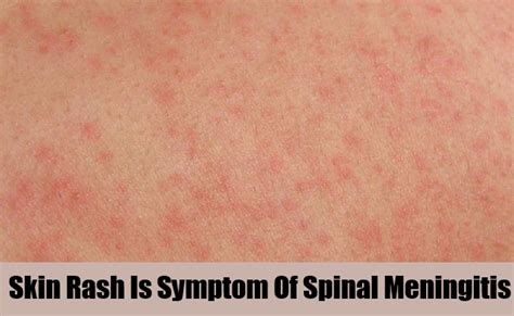 15 Symptoms Of Spinal Meningitis Natural Home Remedies