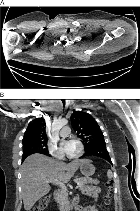 Ct Chest With Contrast Showed An Enlarged Right Lobe Thyroid Gland With