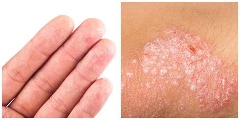 Eczema Or Psoriasis Whats The Difference Genesis Dermatology