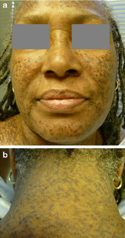 Blue Gray Reticular Hyperpigmentation On The Face A And Neck B At