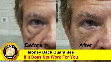 Reduce Under Eye Bags Without Surgery Reduce Under Eye Bags Youtube