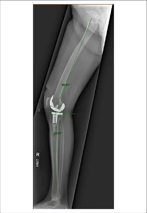 Lower Limb Sagittal View Radiograph Sagittal Femoral Component Angle