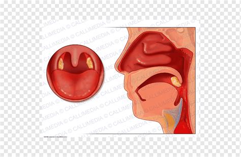 Tonsilitis Adenoid Faring Otorhinolaringologi Hidung Orang Jantung