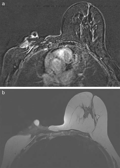 T1 A And T2 B Weighted Mr Images Showing Hypointense Lesion With