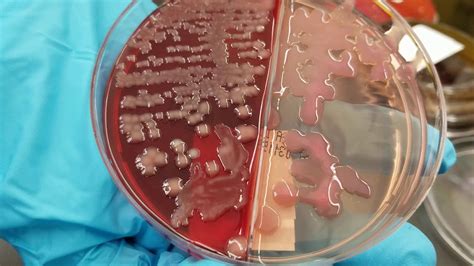 Microbiology Normal Versus Pathogenic Bacteria In Urine Wound And
