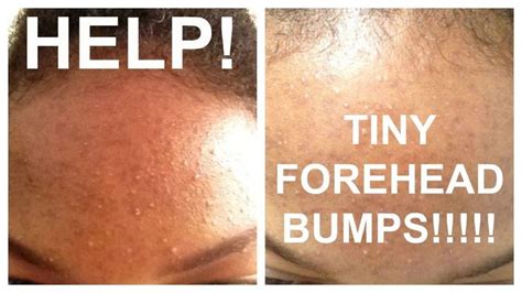 How To Get Rid Of Tiny Forehead Bumps Forehead Acne Forehead