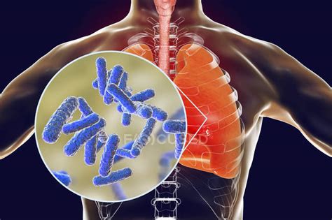 Learn about causes, risk factors, prevention, signs and symptoms. Los pulmones con neumonía bacteriana y primer plano de las ...