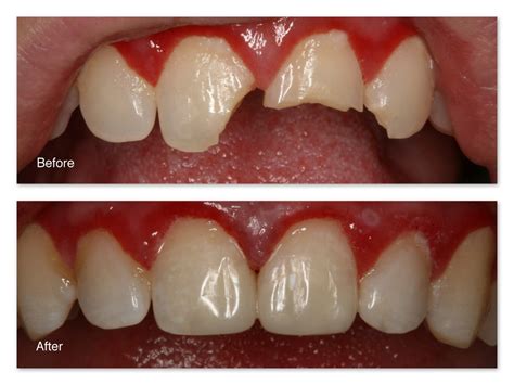 Tooth Colored Fillings Gallery Dr Jack M Hosner Dds