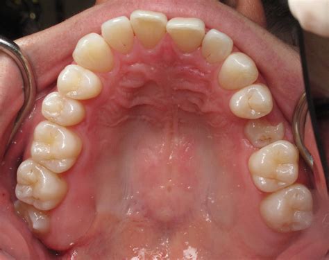 Wisdom Teeth Extractioncoronectomy With Simultaneous Baby Tooth Dental